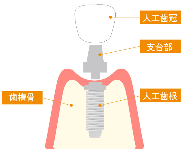 インプラントの構造
