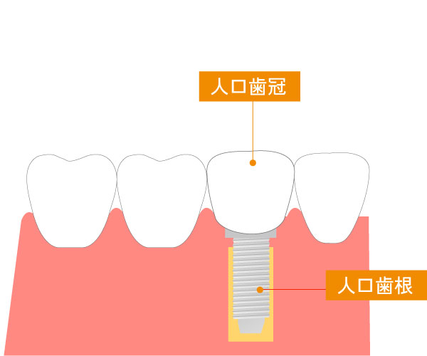 インプラント