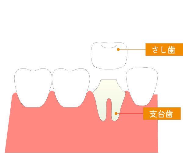 さし歯